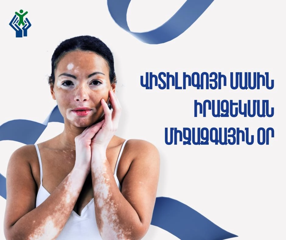 What is Vitiligo? 